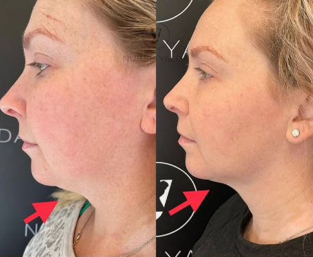 Kybella - Rejuvenation Clinic - Vienna Med Spa