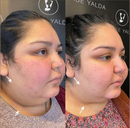 Kybella - Rejuvenation Clinic - Vienna Med Spa