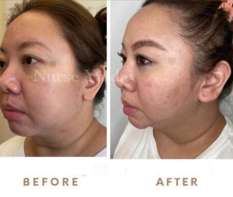 Kybella - Rejuvenation Clinic - Vienna Med Spa