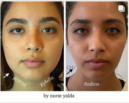 Kybella - Rejuvenation Clinic - Vienna Med Spa