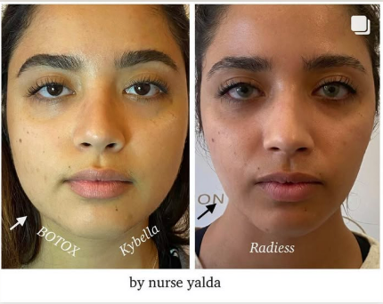 Kybella - Rejuvenation Clinic - Vienna Med Spa