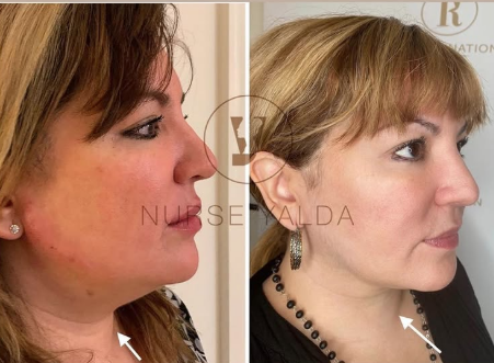Kybella - Rejuvenation Clinic - Vienna Med Spa