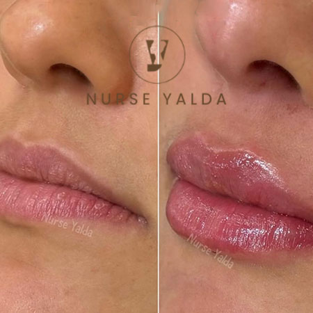 Lip Filler - Promotion - Rejuvenation Clinic - Vienna Med Spa