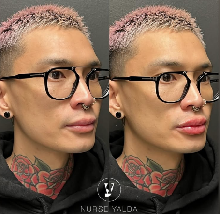 Lip Fillers - Rejuvenation Clinic - Vienna Med Spa