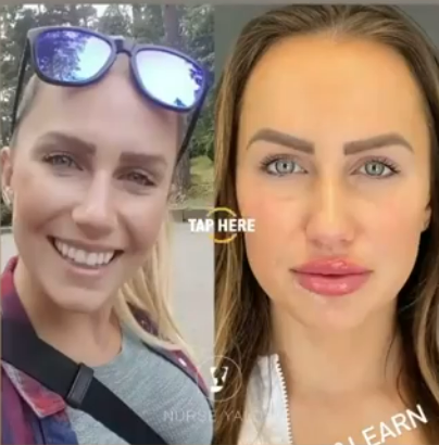 Lip Fillers - Rejuvenation Clinic - Vienna Med Spa