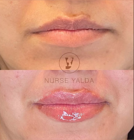 Lip Fillers - Rejuvenation Clinic - Vienna Med Spa