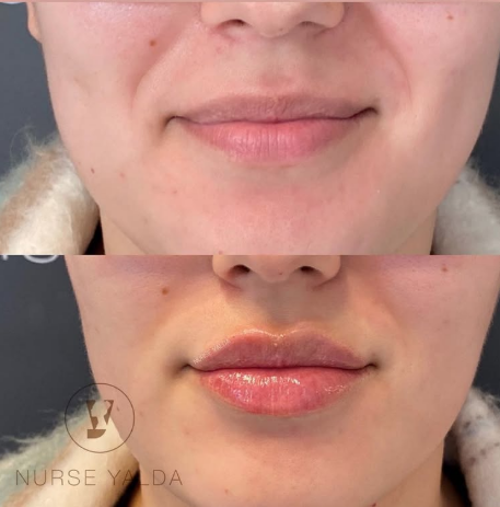 Lip Fillers - Rejuvenation Clinic - Vienna Med Spa