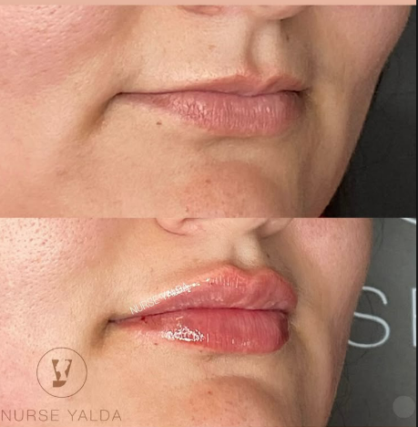 Lip Fillers - Rejuvenation Clinic - Vienna Med Spa