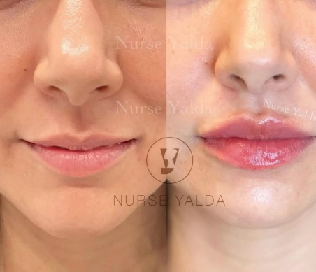 Lip Fillers - Rejuvenation Clinic - Vienna Med Spa