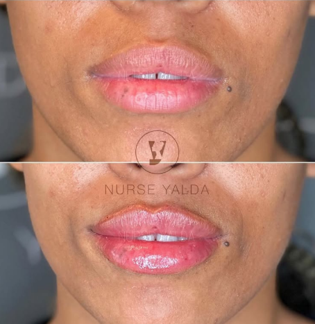 Lip Fillers - Rejuvenation Clinic - Vienna Med Spa