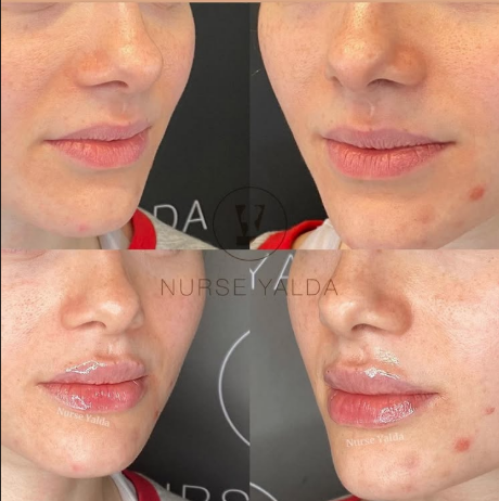 Lip Fillers - Rejuvenation Clinic - Vienna Med Spa