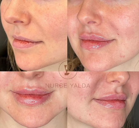 Lip Fillers - Rejuvenation Clinic - Vienna Med Spa