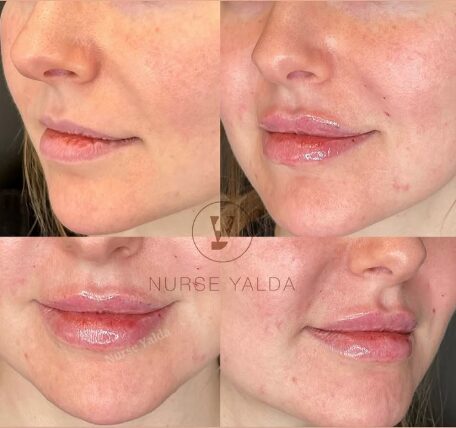 Lip Fillers - Rejuvenation Clinic - Vienna Med Spa