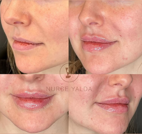 Lip Fillers - Rejuvenation Clinic - Vienna Med Spa