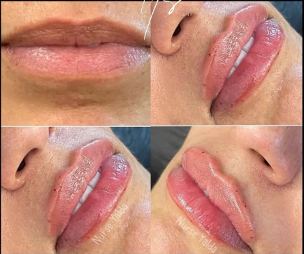 Lip Fillers - Rejuvenation Clinic - Vienna Med Spa