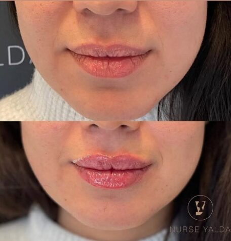 Lip Fillers - Rejuvenation Clinic - Vienna Med Spa