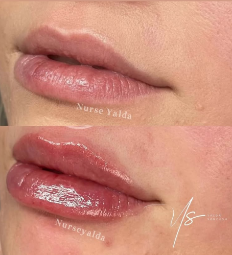Lip Fillers - Rejuvenation Clinic - Vienna Med Spa