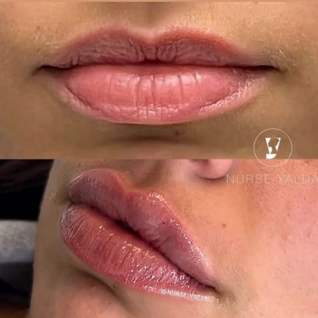 Lip Fillers - Rejuvenation Clinic - Vienna Med Spa