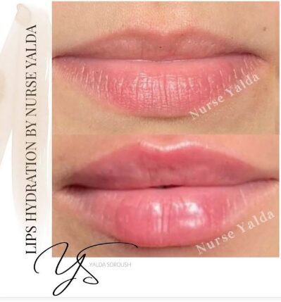 Lip Fillers - Rejuvenation Clinic - Vienna Med Spa