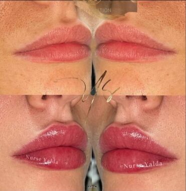 Lip Fillers - Rejuvenation Clinic - Vienna Med Spa