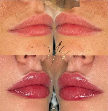 Lip Fillers - Rejuvenation Clinic - Vienna Med Spa