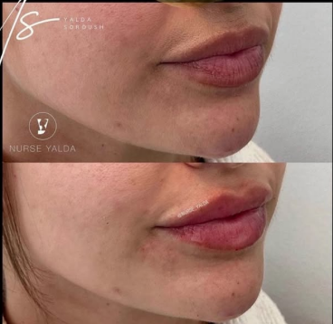 Lip Fillers - Rejuvenation Clinic - Vienna Med Spa