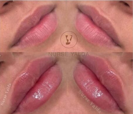 Lip Fillers - Rejuvenation Clinic - Vienna Med Spa