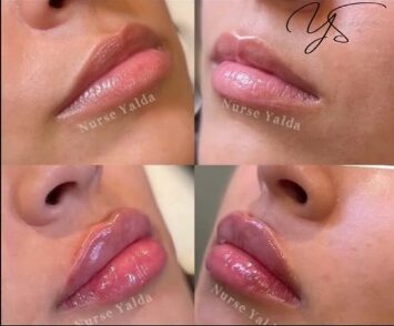 Lip Fillers - Rejuvenation Clinic - Vienna Med Spa
