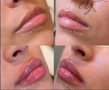 Lip Fillers - Rejuvenation Clinic - Vienna Med Spa